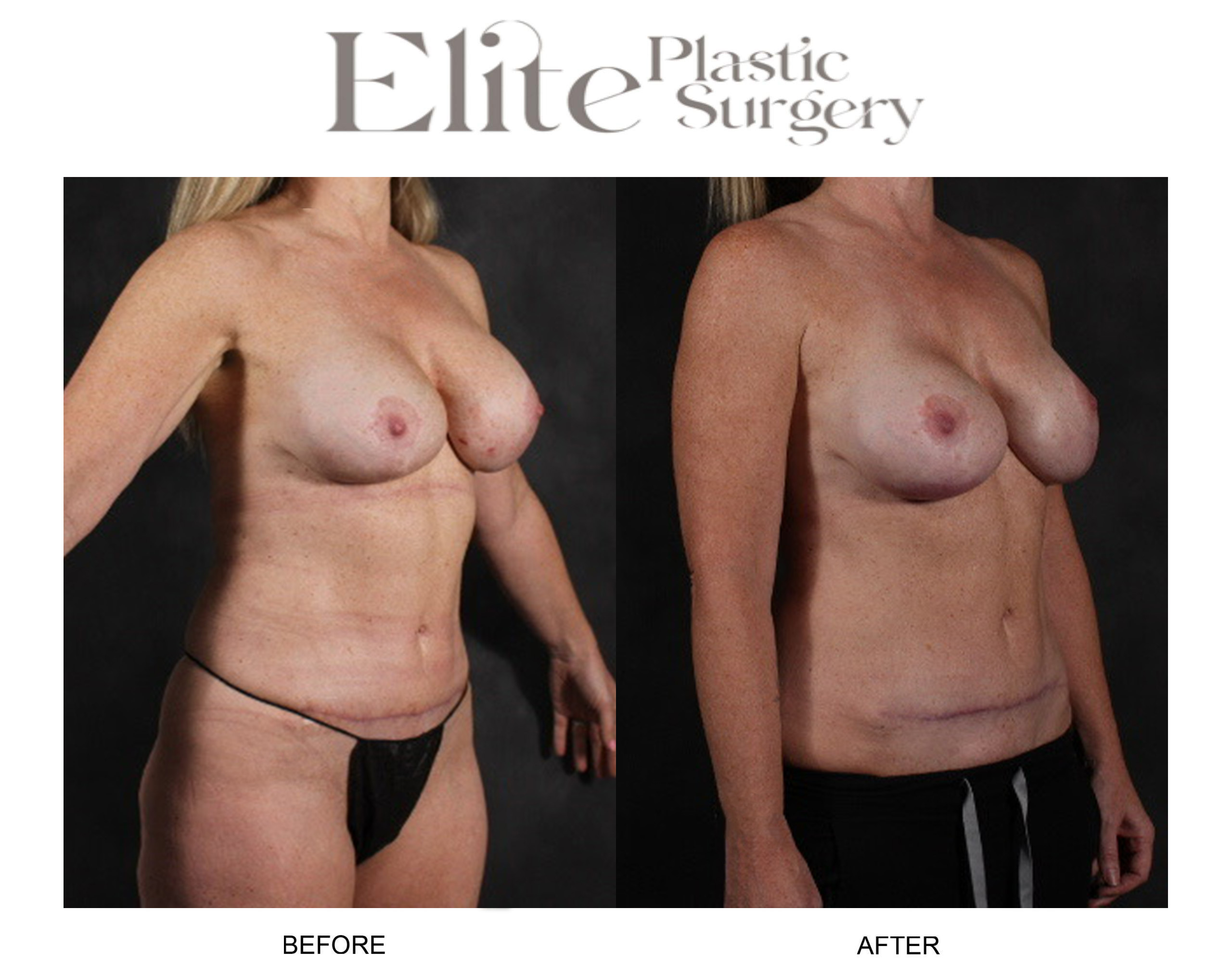 Abdominoplasty (Tummy Tuck) Before & After Gallery - Patient 141871 - Image 2
