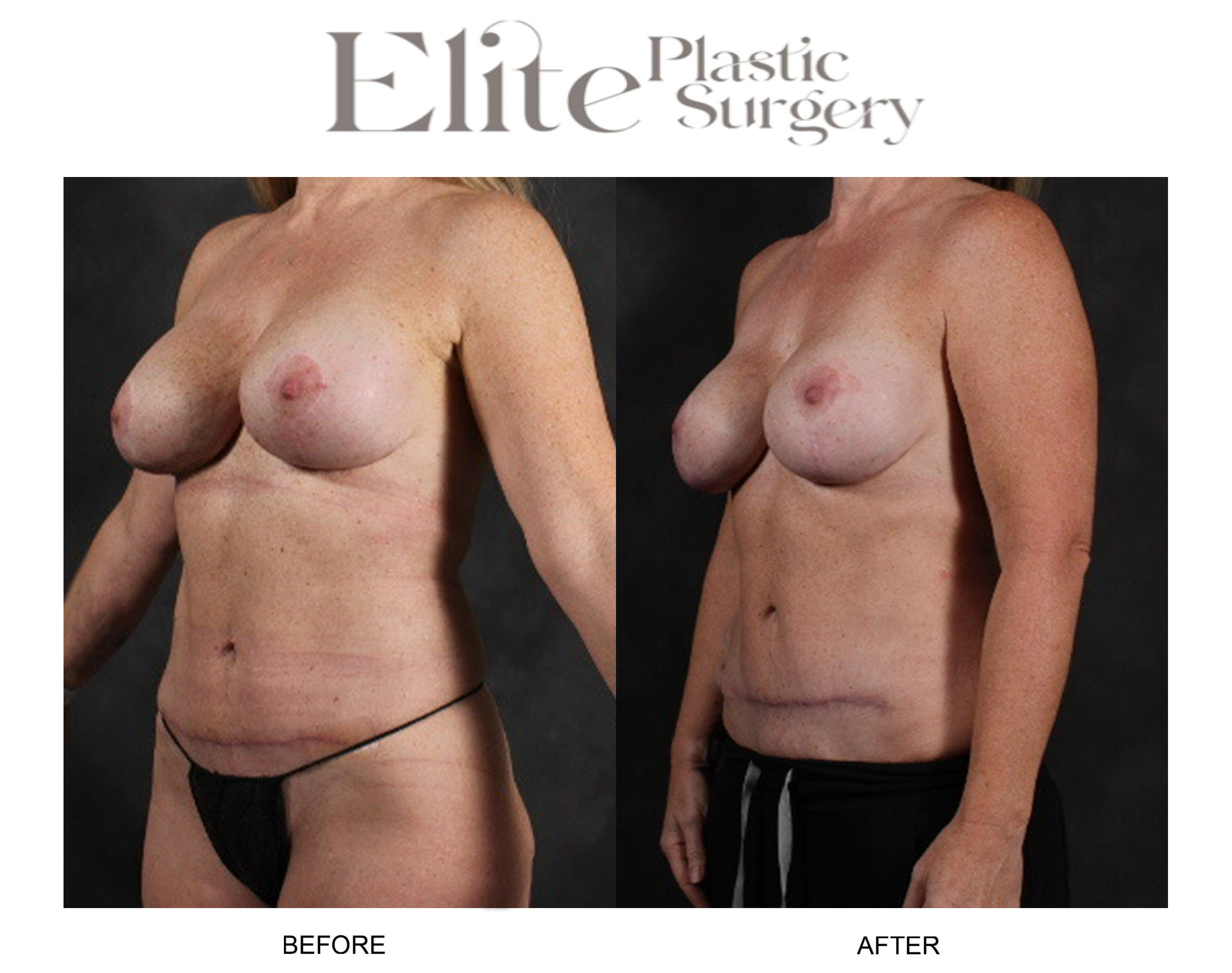Abdominoplasty (Tummy Tuck) Before & After Gallery - Patient 141871 - Image 3