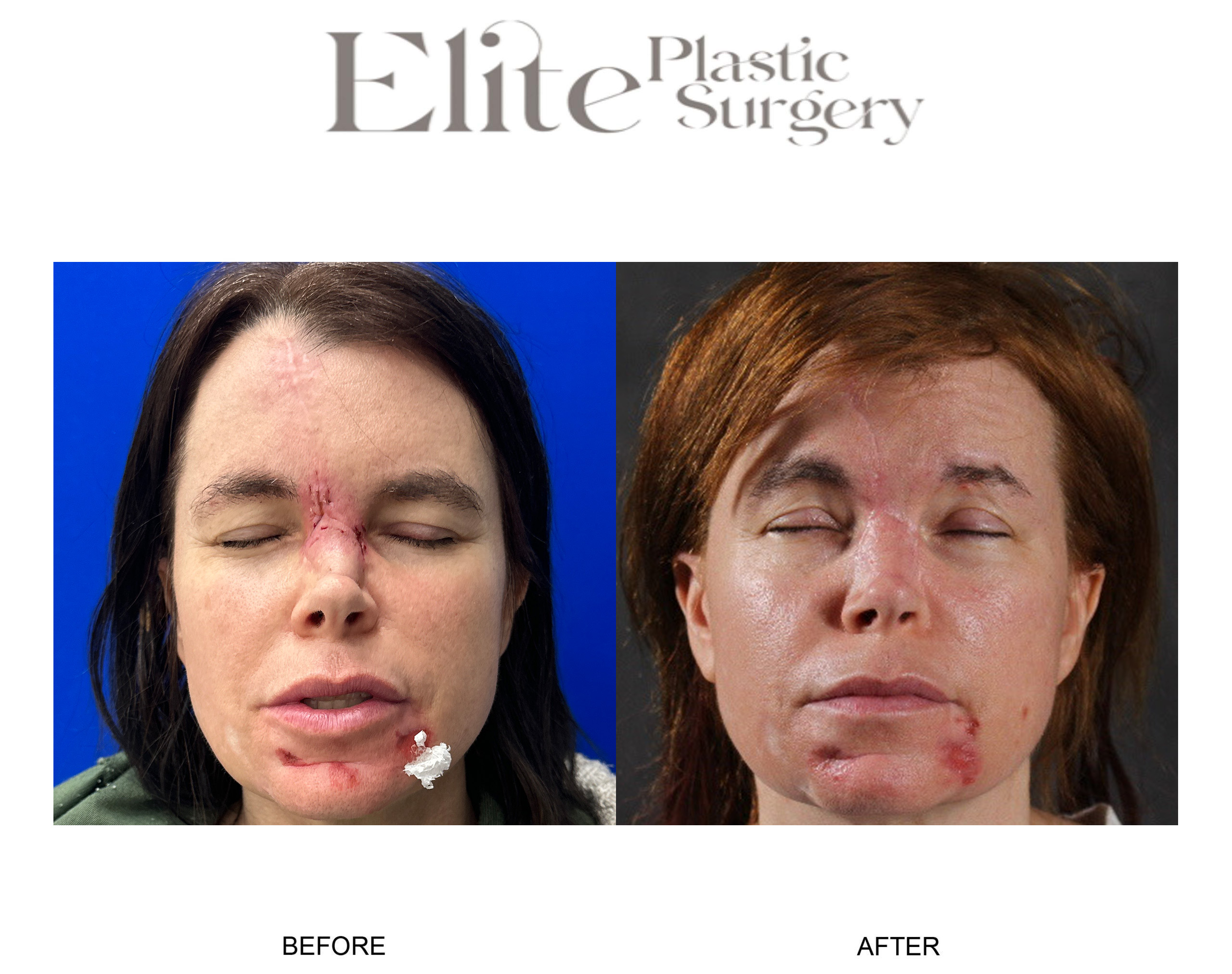 Facial Reconstruction Before & After Gallery - Patient 291811 - Image 1