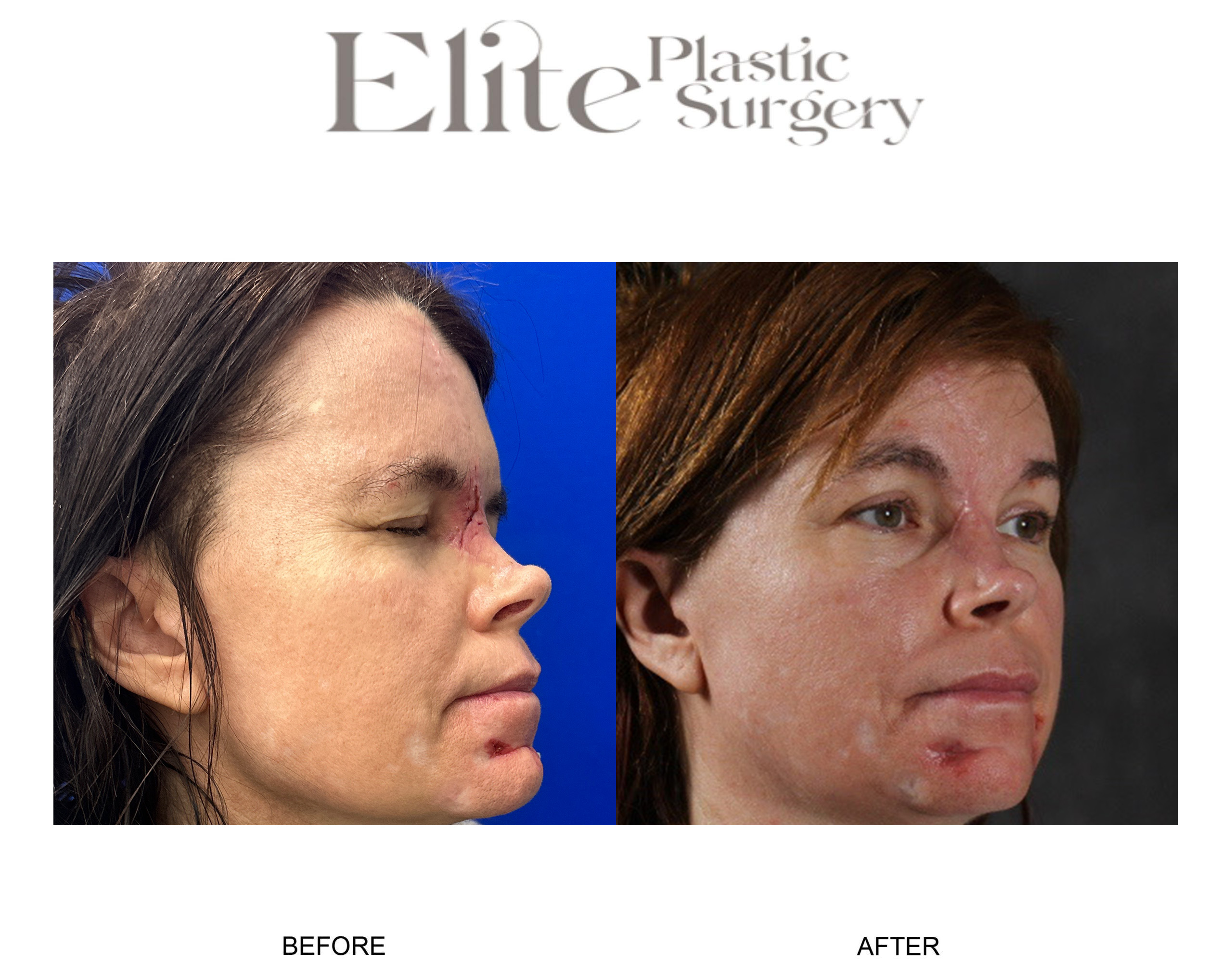 Facial Reconstruction Before & After Gallery - Patient 291811 - Image 3