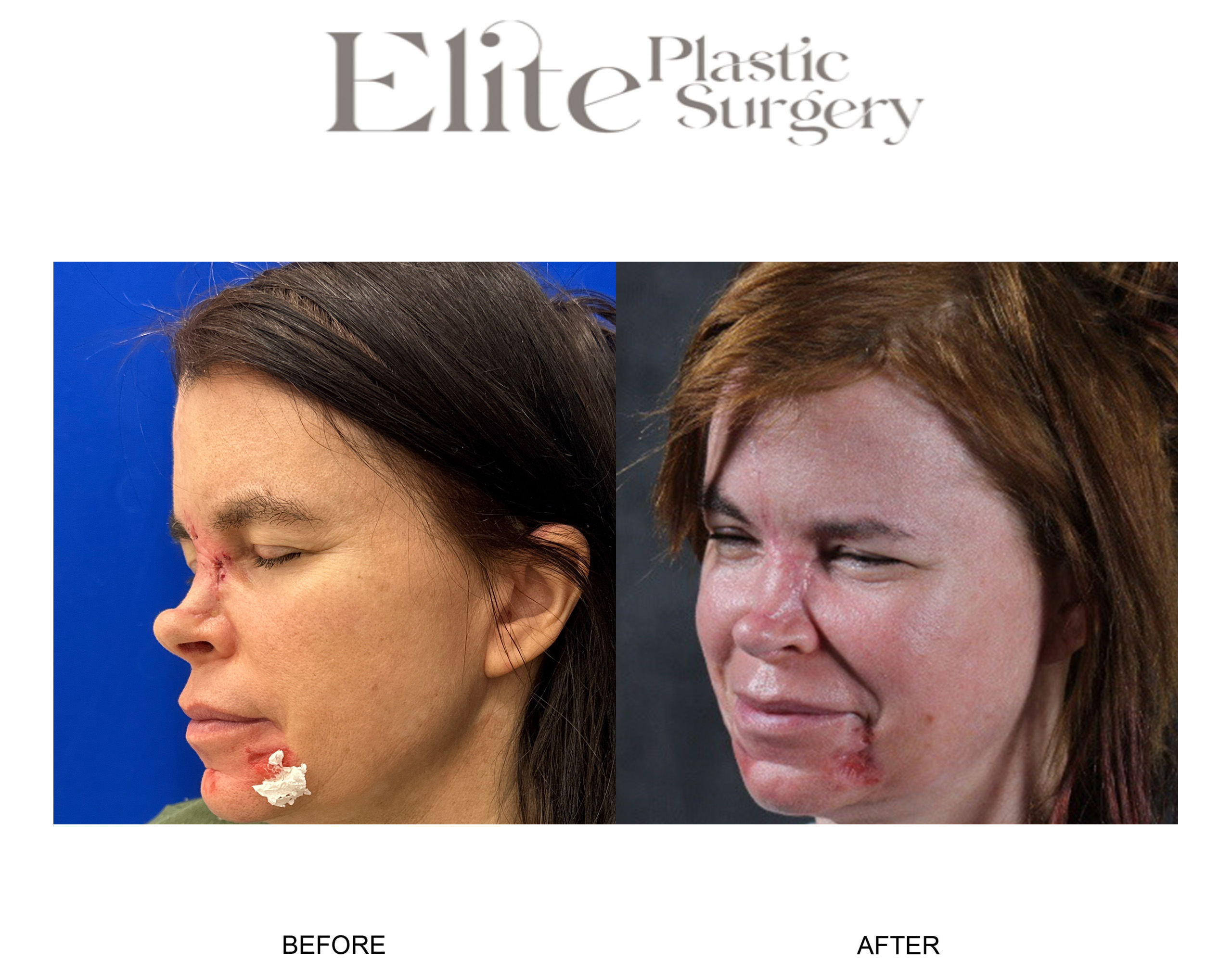 Facial Reconstruction Before & After Gallery - Patient 291811 - Image 4