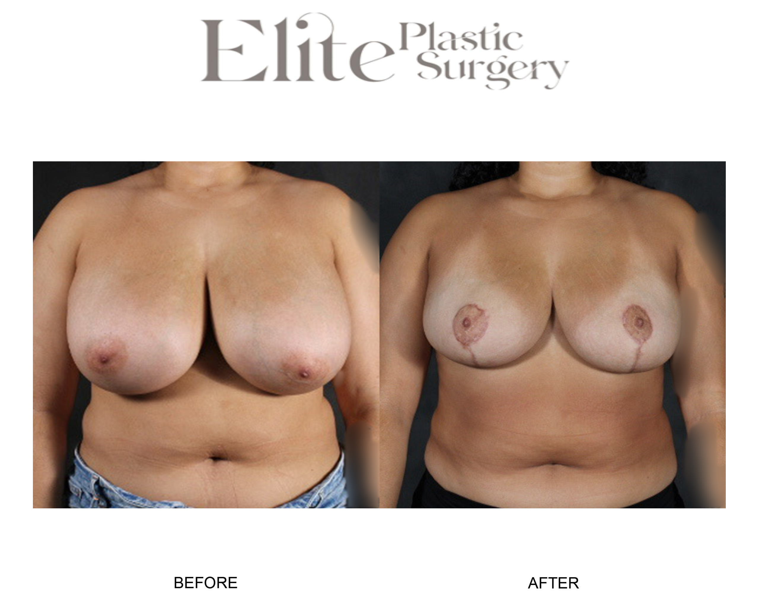 Breast Reduction Before & After Gallery - Patient 283309 - Image 1