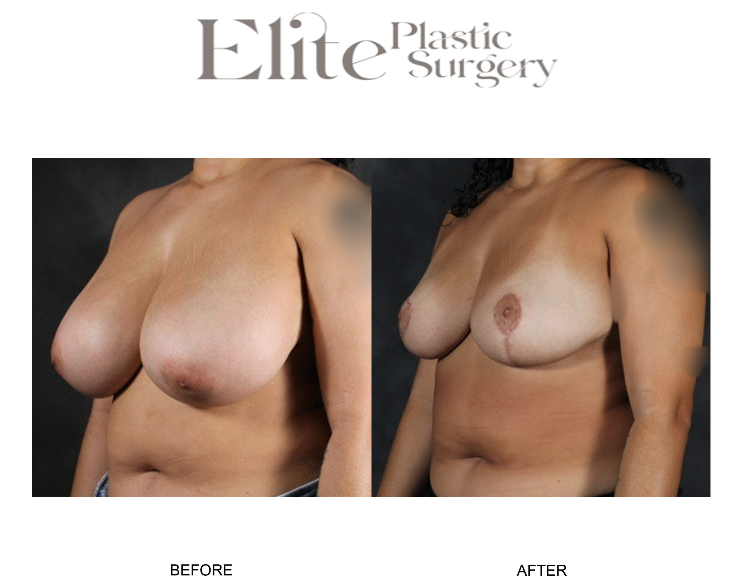 Breast Reduction Before & After Gallery - Patient 283309 - Image 2