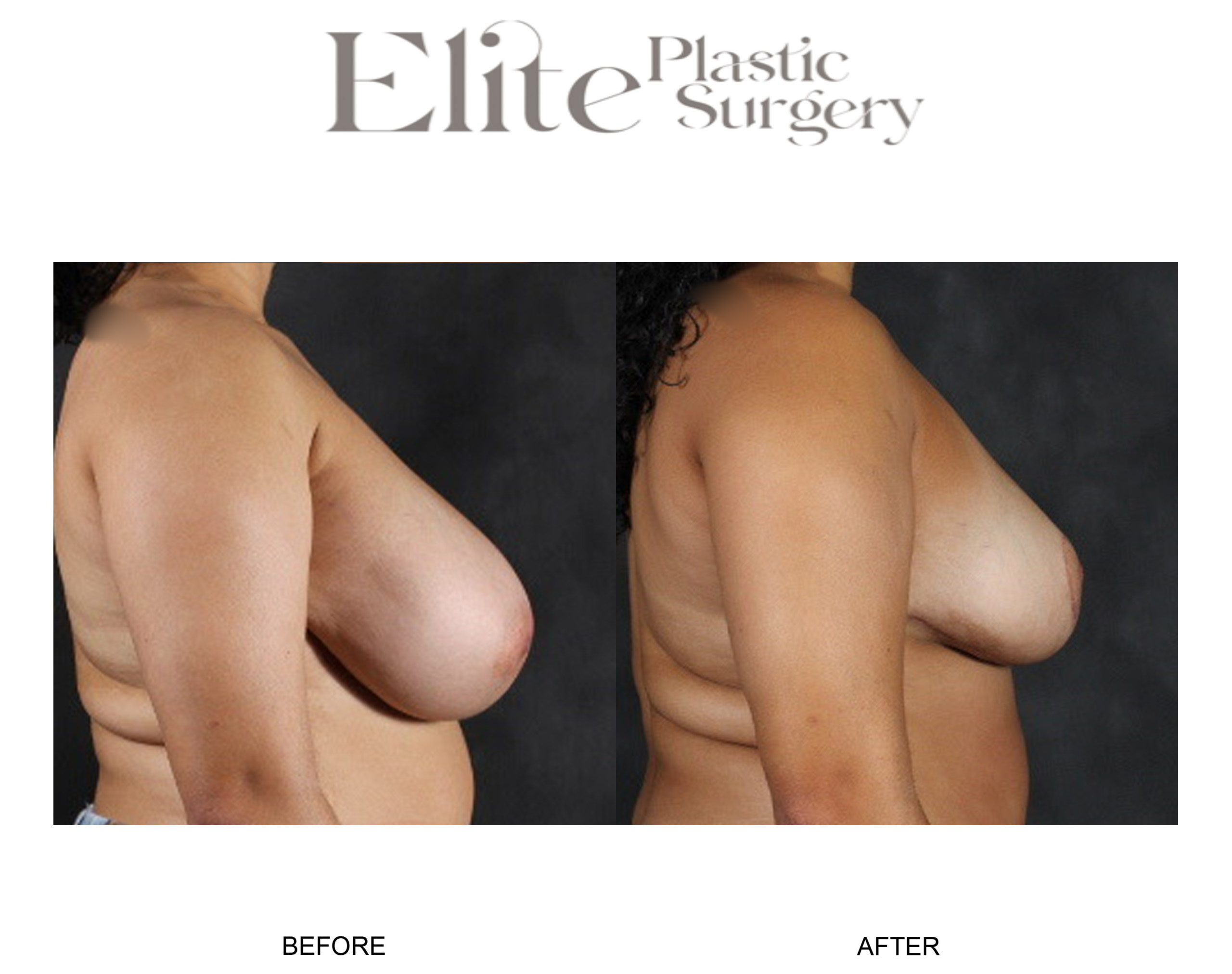 Breast Reduction Before & After Gallery - Patient 283309 - Image 4