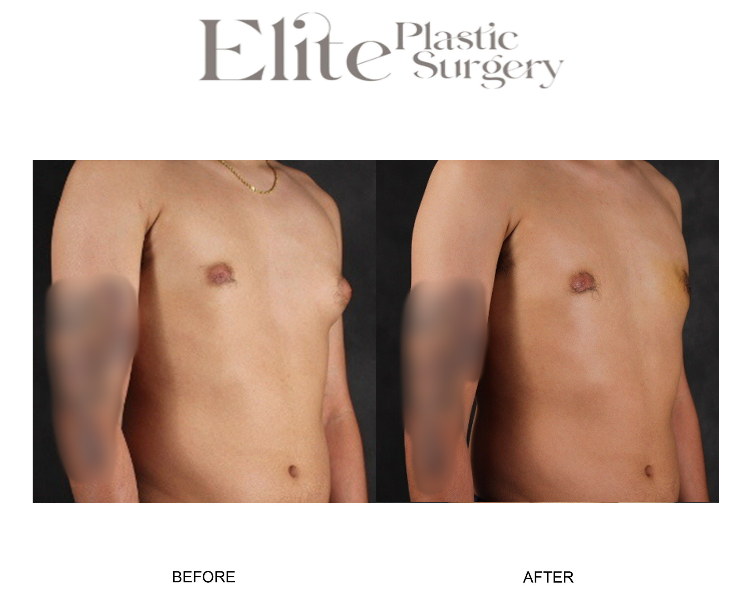 Male Gynecomastia Before & After Gallery - Patient 140838 - Image 1