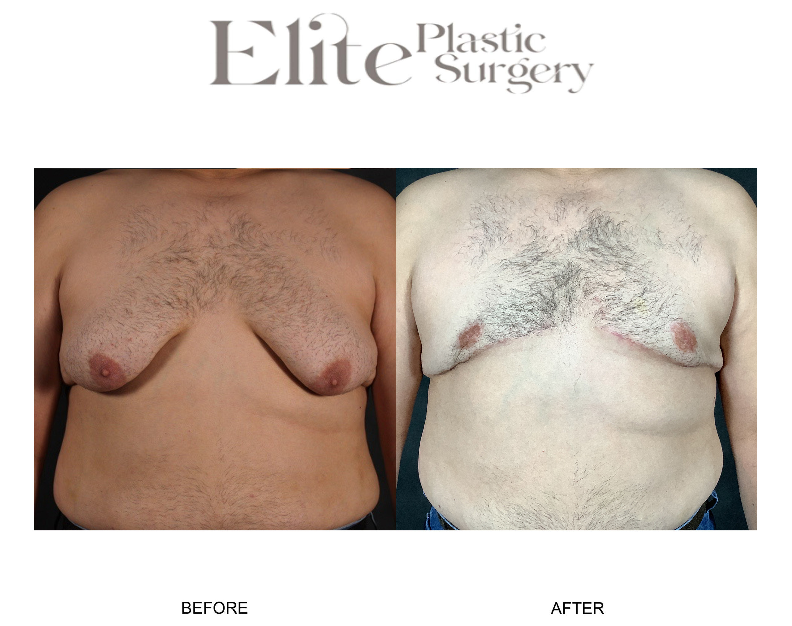 Male Gynecomastia Before & After Gallery - Patient 232924 - Image 1
