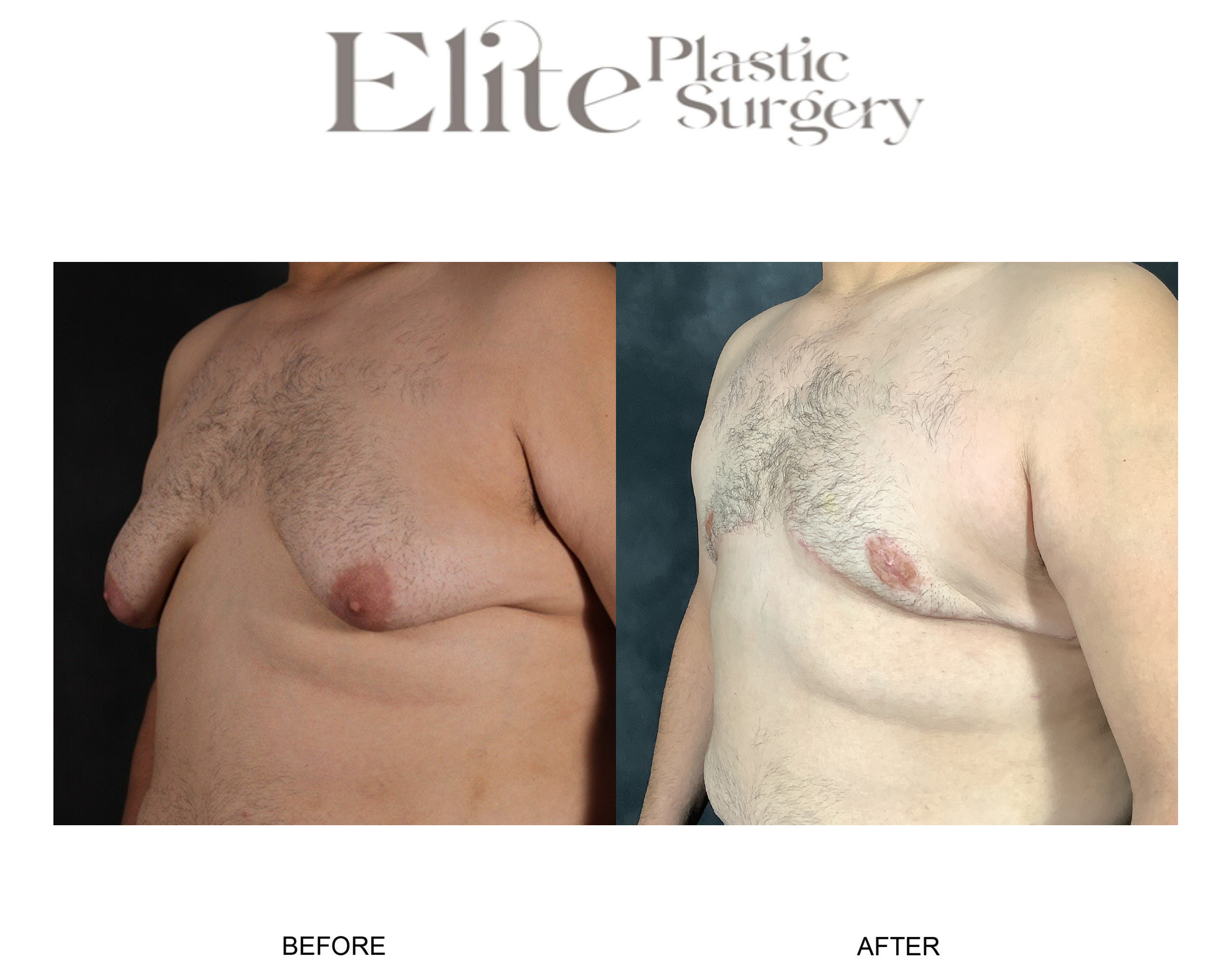Male Gynecomastia Before & After Gallery - Patient 232924 - Image 2