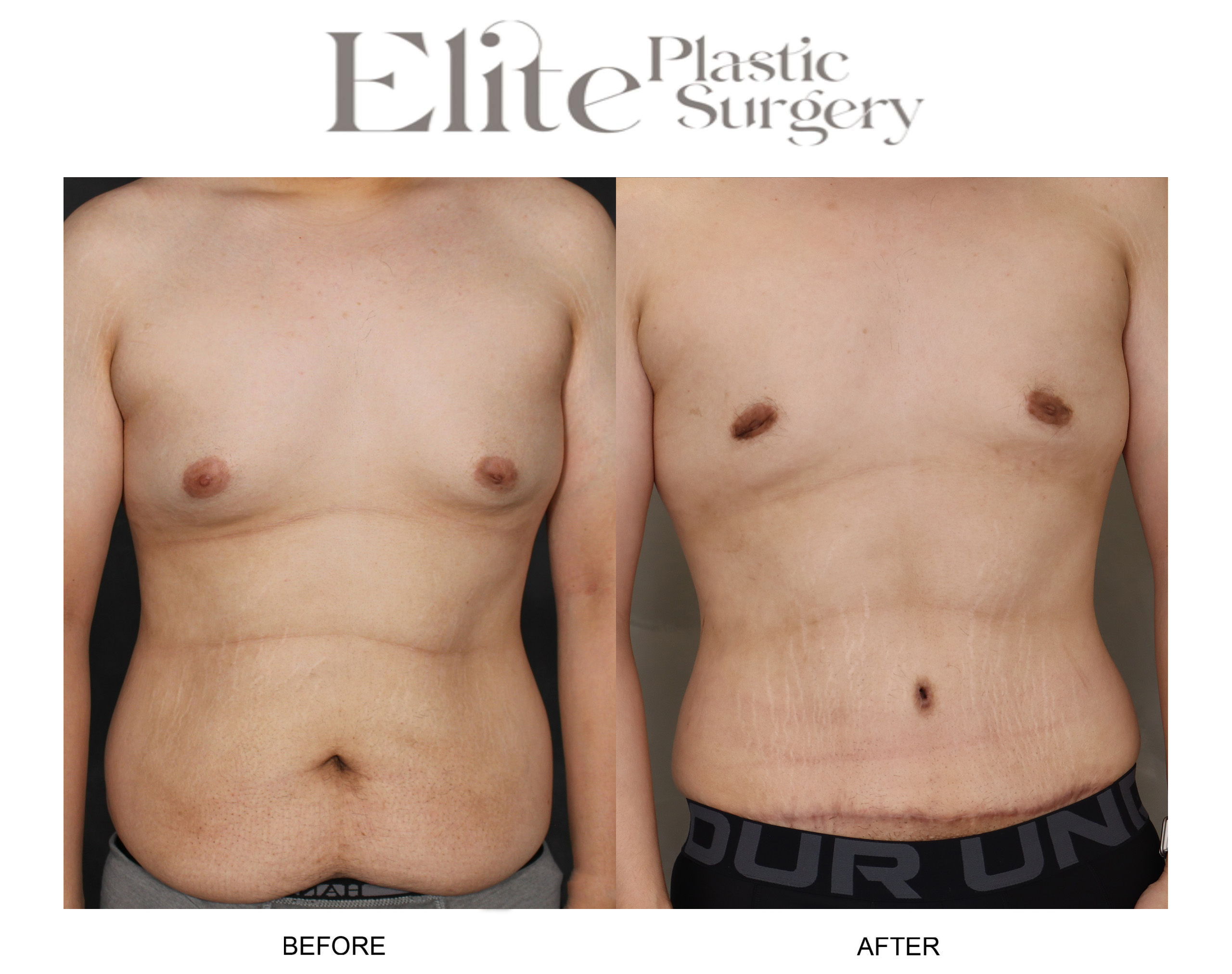 Abdominoplasty (Tummy Tuck) Before & After Gallery - Patient 271723 - Image 1