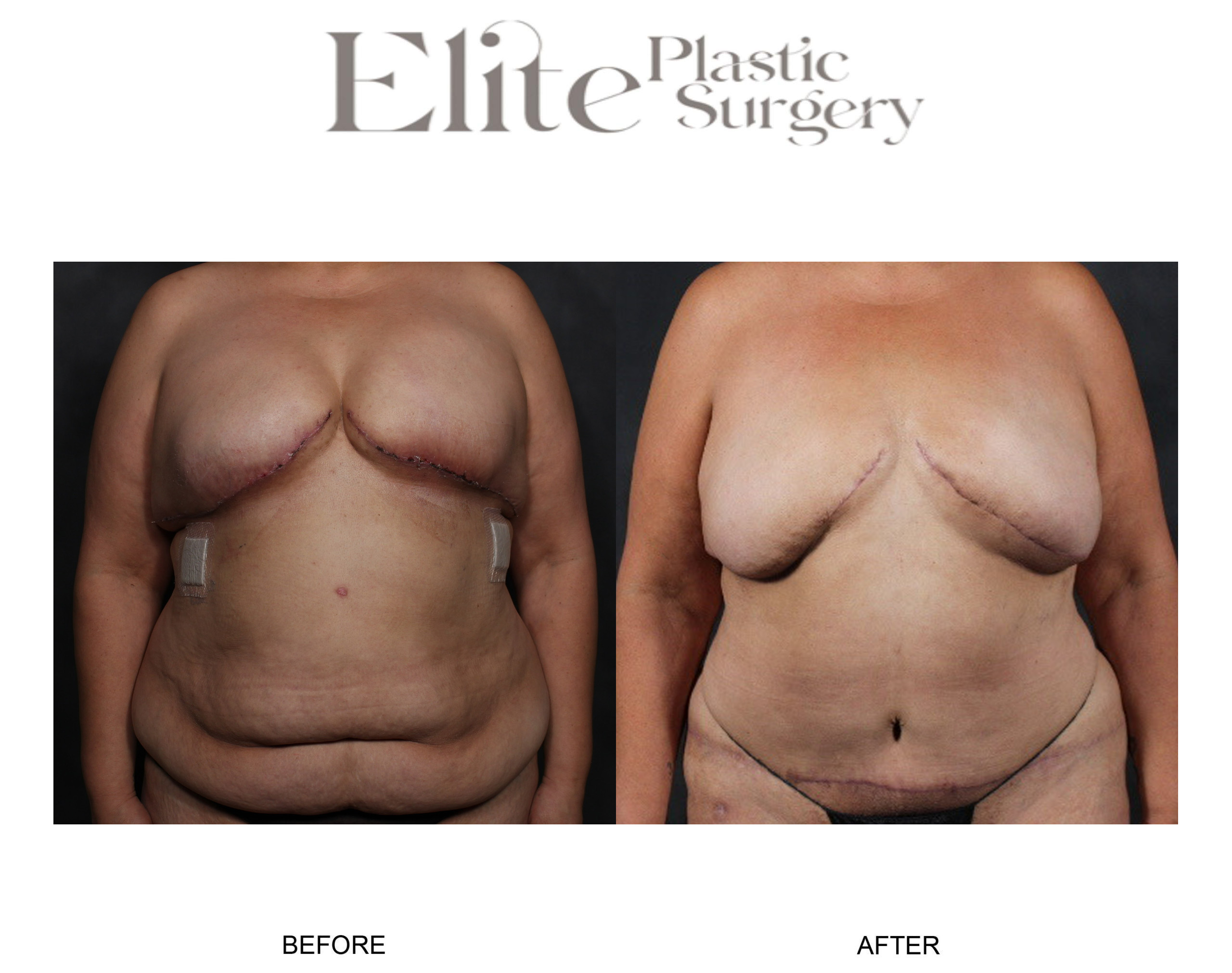 DIEP Breast Reconstruction Before & After Gallery - Patient 348134 - Image 1