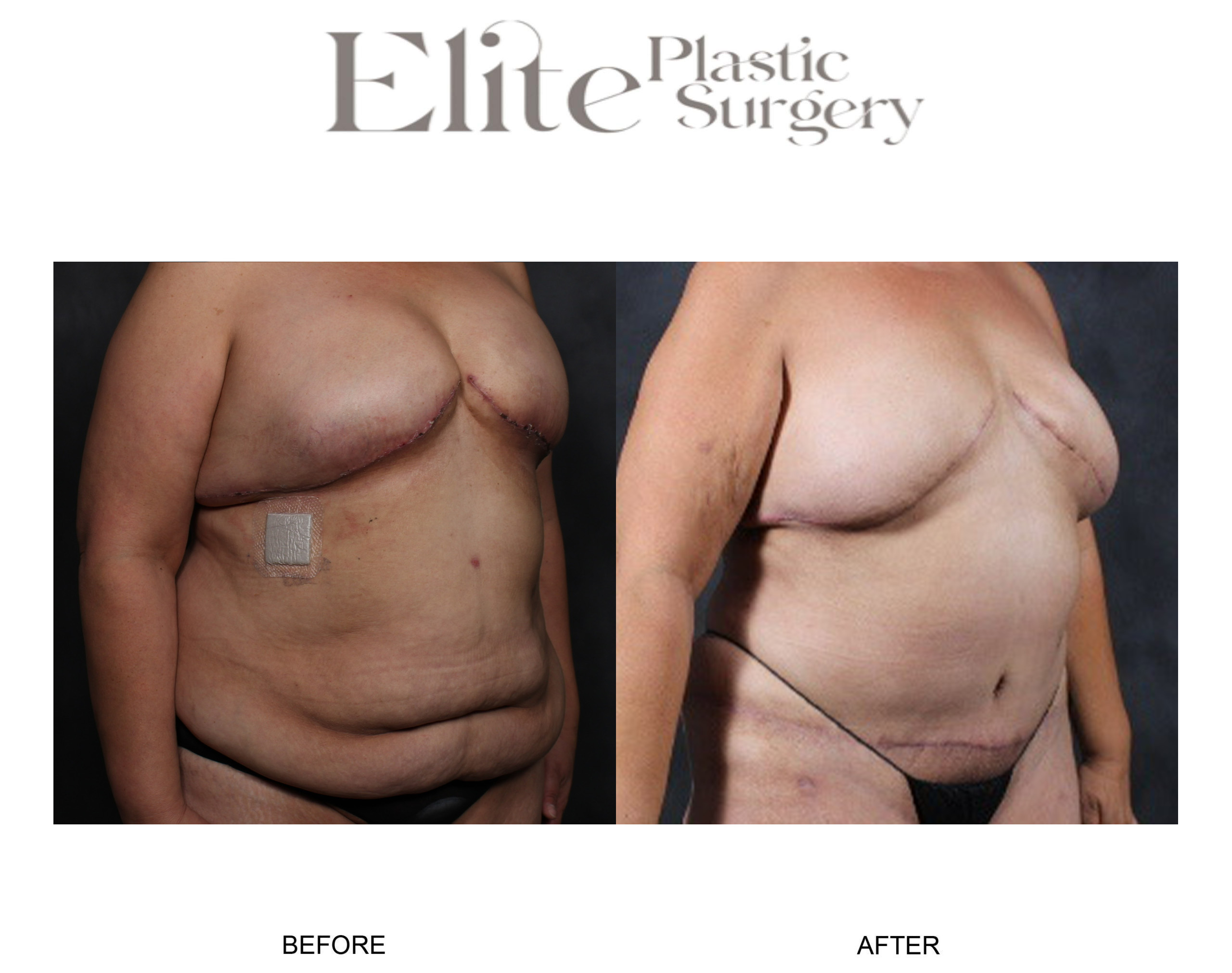 DIEP Breast Reconstruction Before & After Gallery - Patient 348134 - Image 2