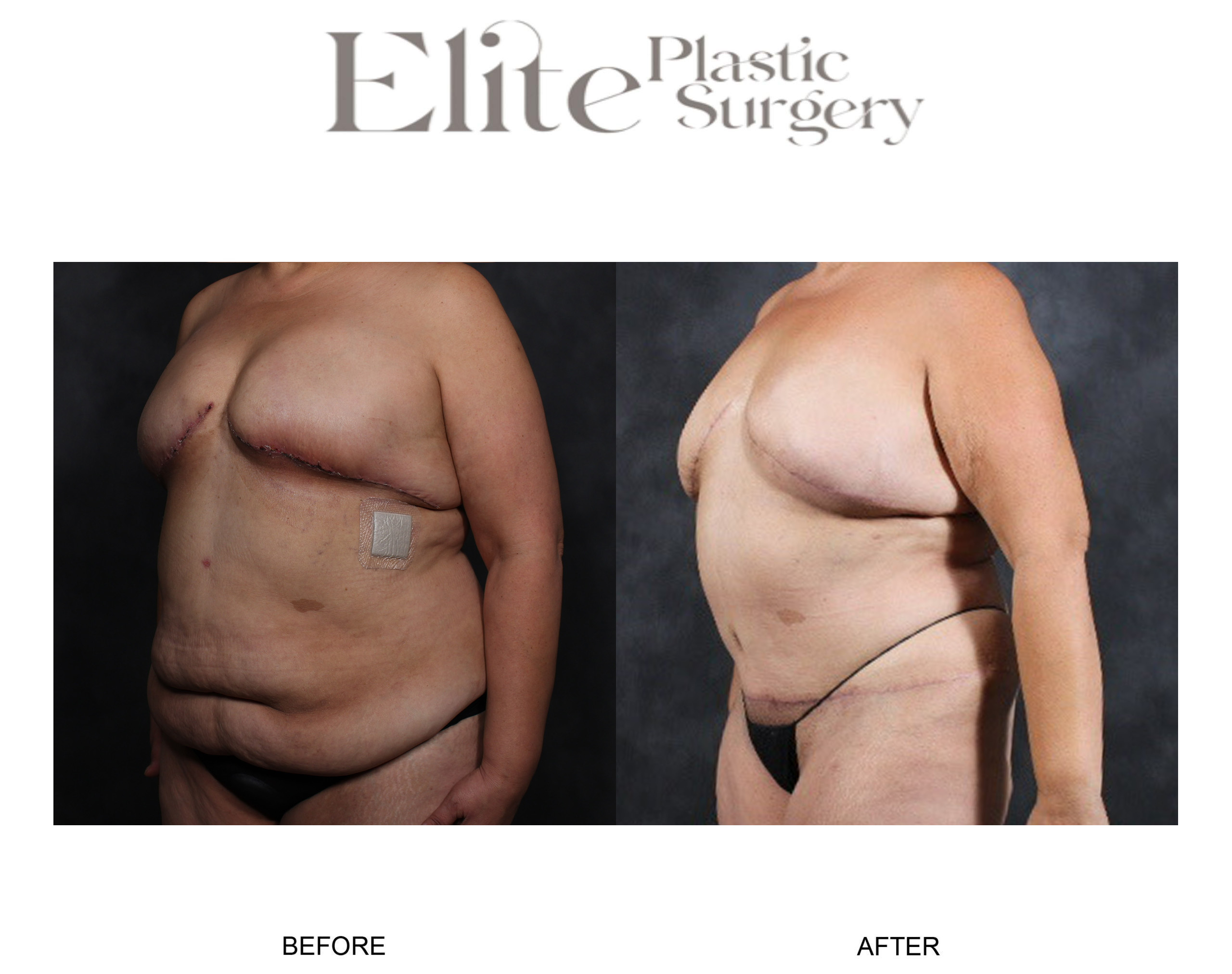 DIEP Breast Reconstruction Before & After Gallery - Patient 348134 - Image 3
