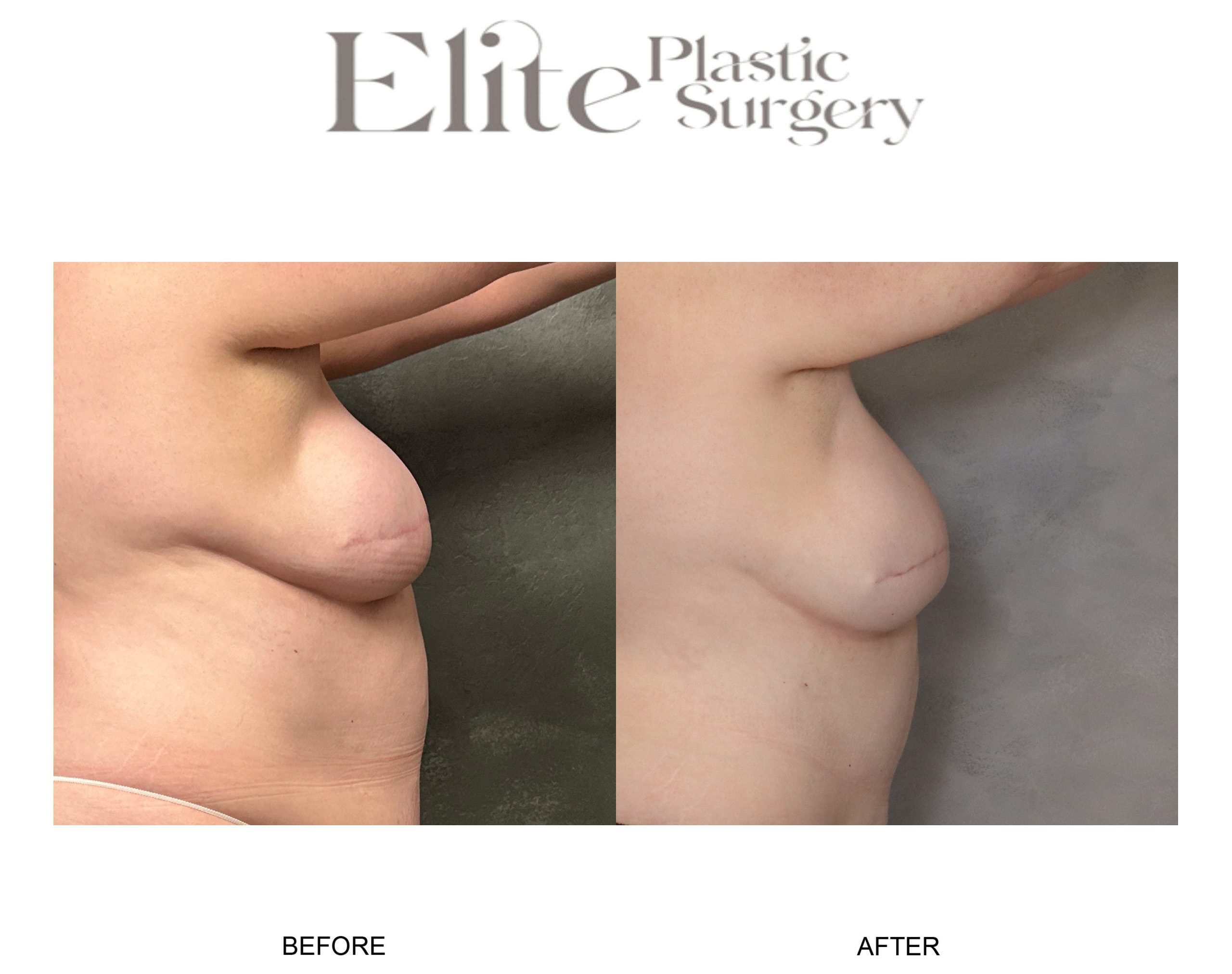 DIEP Breast Reconstruction Before & After Gallery - Patient 266472 - Image 2