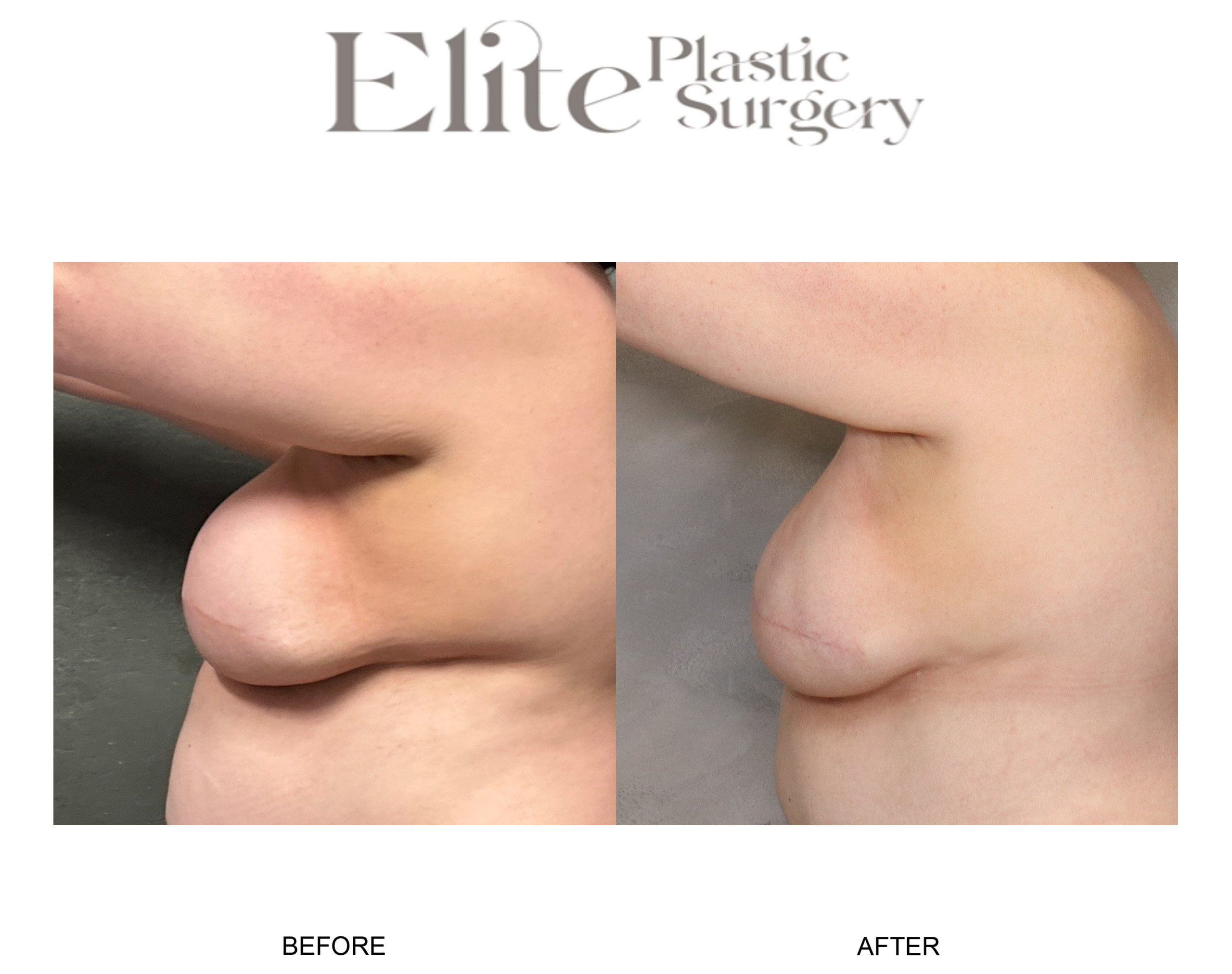 DIEP Breast Reconstruction Before & After Gallery - Patient 266472 - Image 3