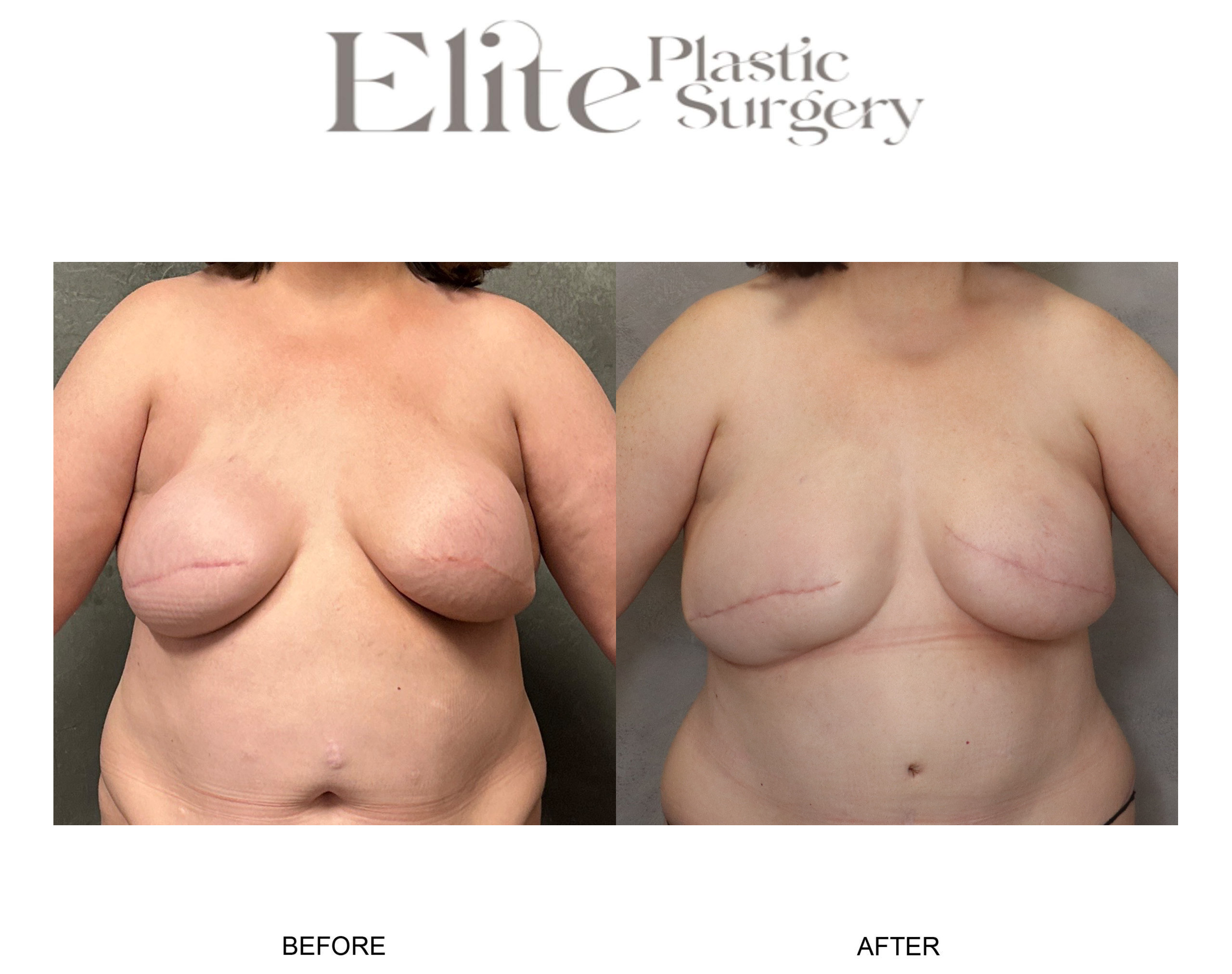 DIEP Breast Reconstruction Before & After Gallery - Patient 266472 - Image 1