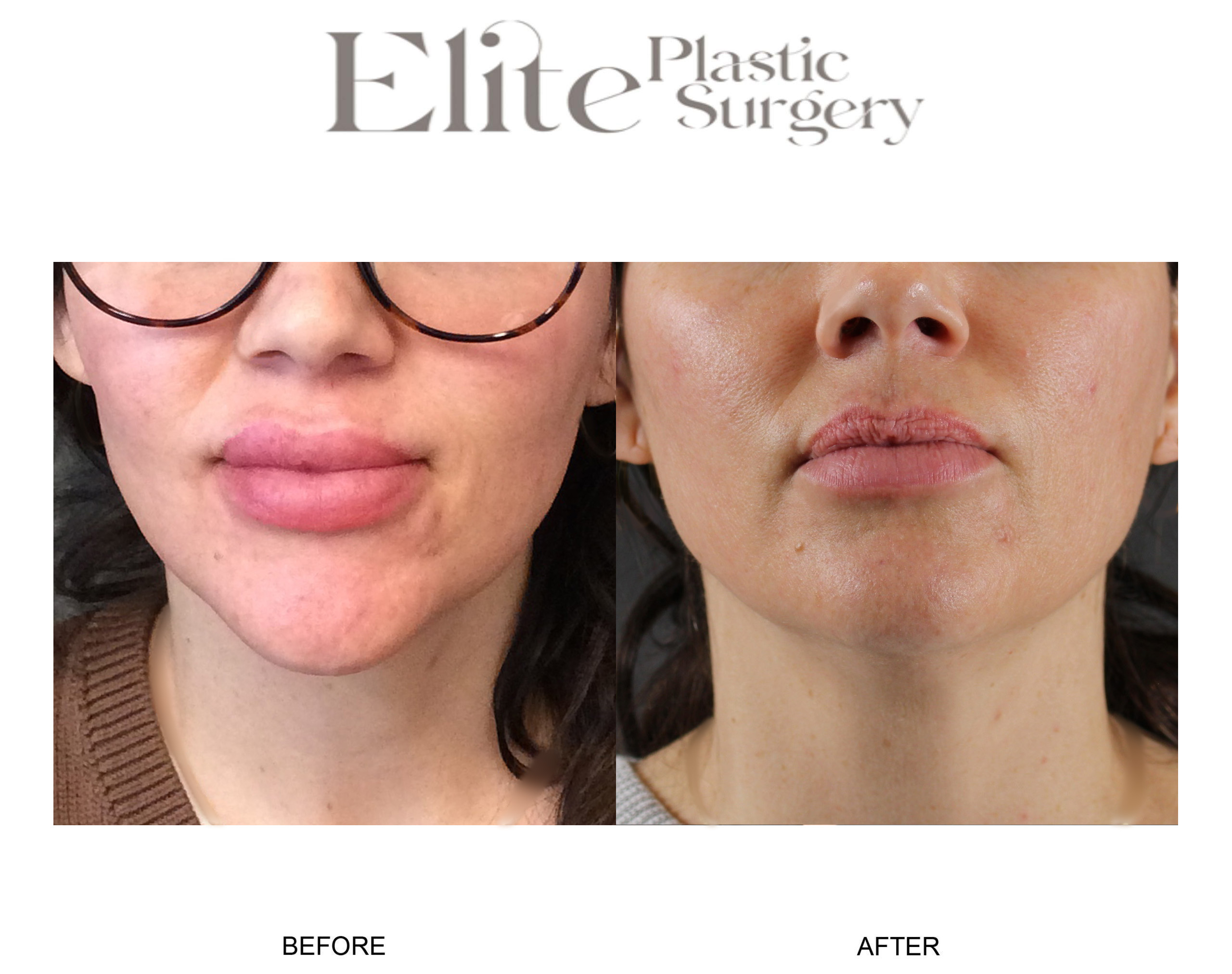 Facial Lesion Removal Before & After Gallery - Patient 401474 - Image 1