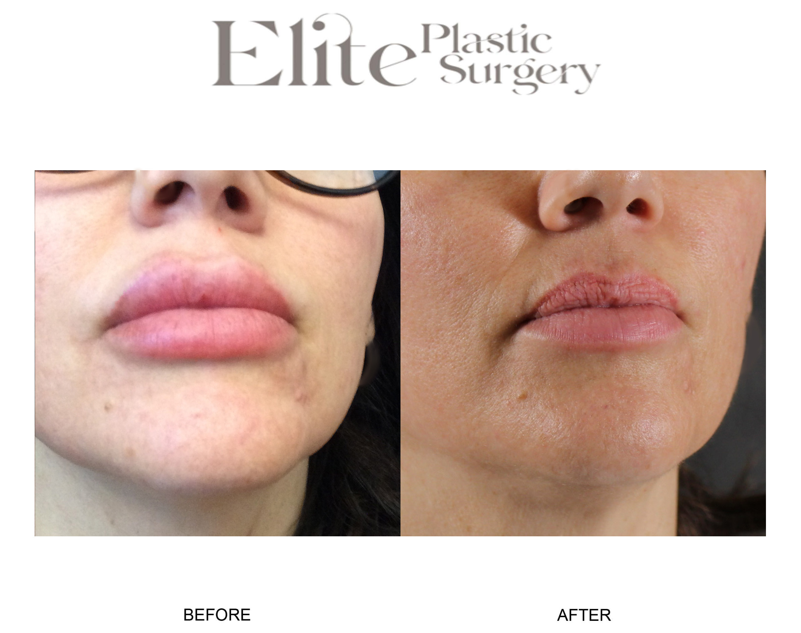 Facial Lesion Removal Before & After Gallery - Patient 401474 - Image 2