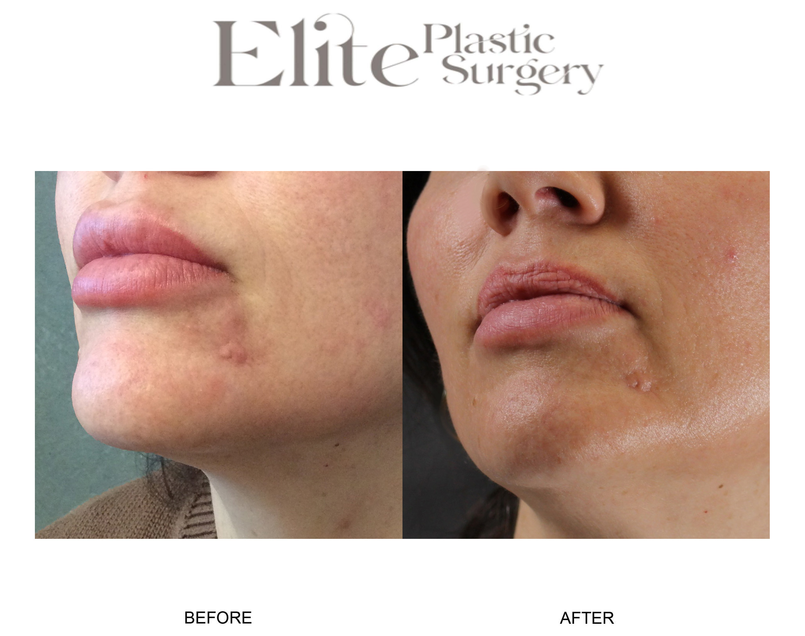 Facial Lesion Removal Before & After Gallery - Patient 401474 - Image 3