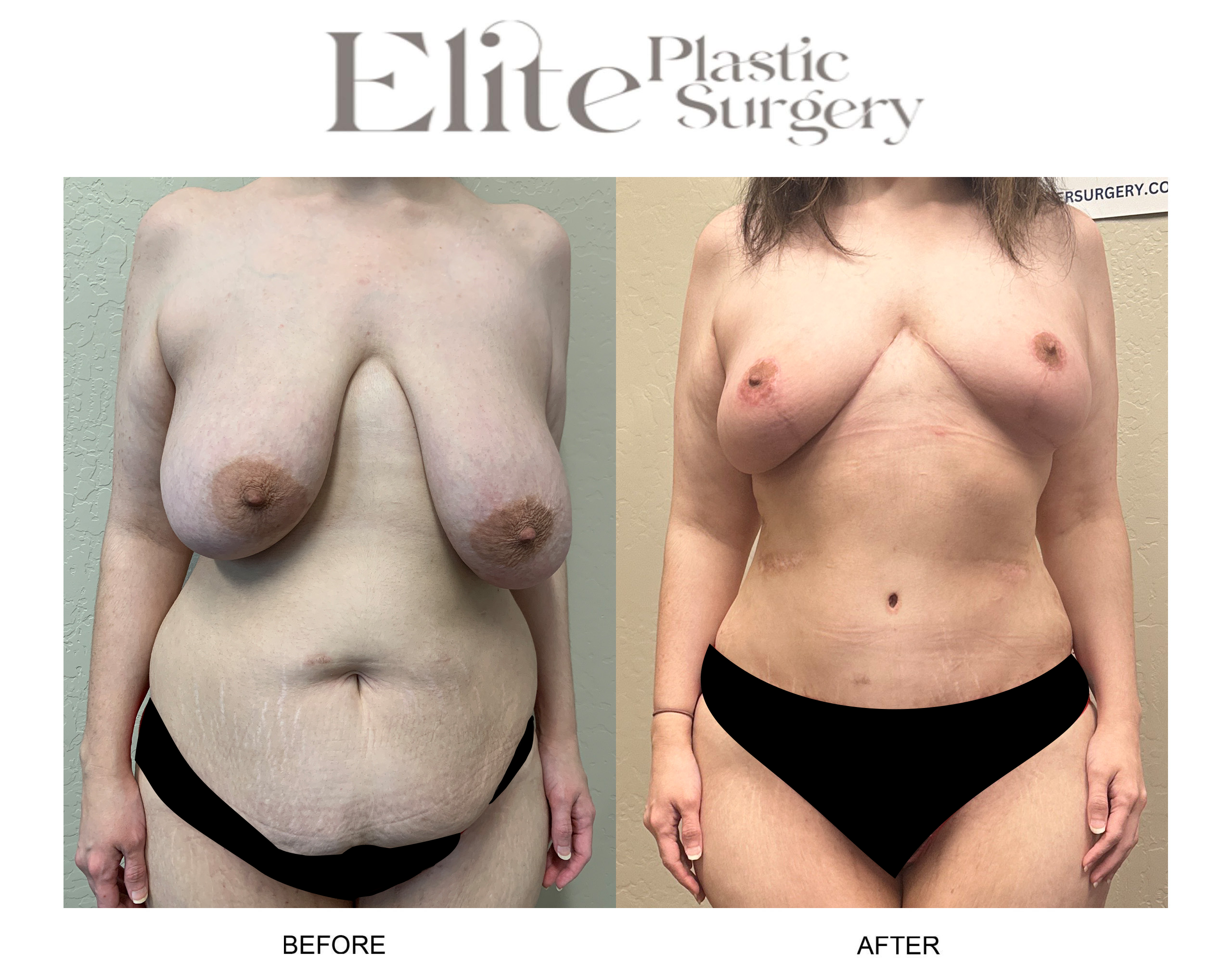 Abdominoplasty (Tummy Tuck) Before & After Gallery - Patient 377836 - Image 1