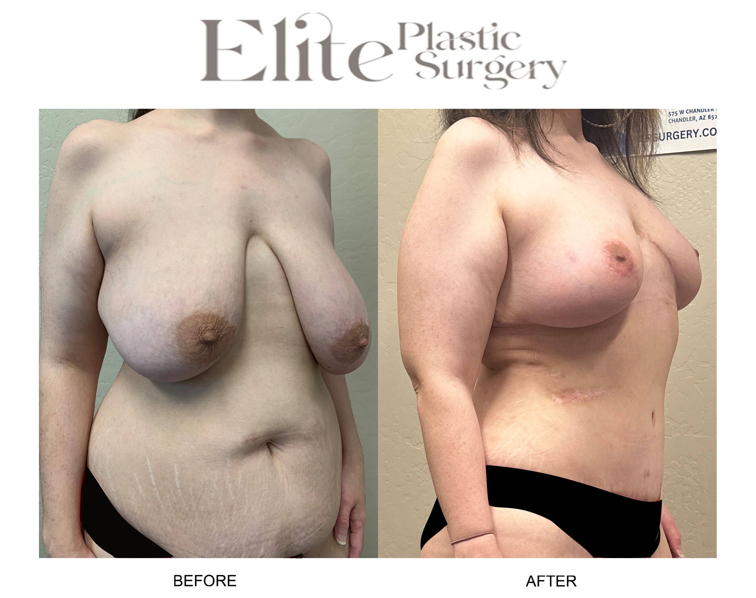 Abdominoplasty (Tummy Tuck) Before & After Gallery - Patient 377836 - Image 2