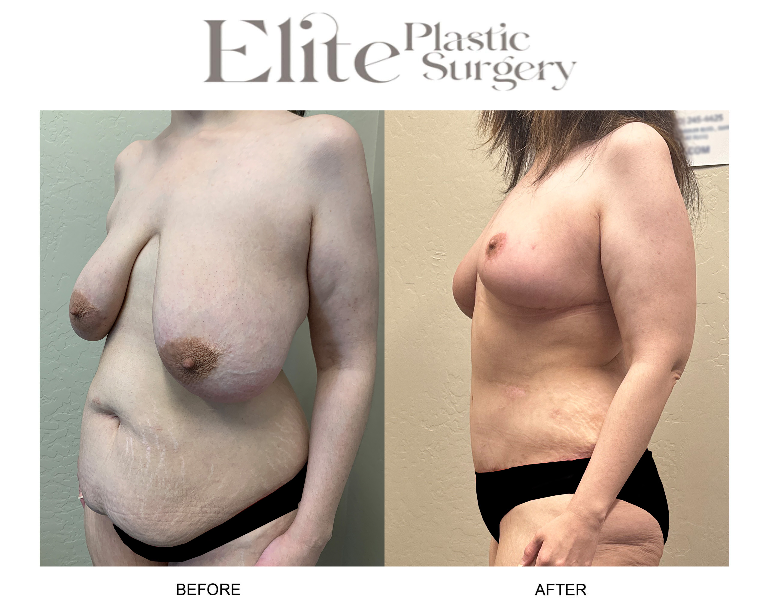 Abdominoplasty (Tummy Tuck) Before & After Gallery - Patient 377836 - Image 3