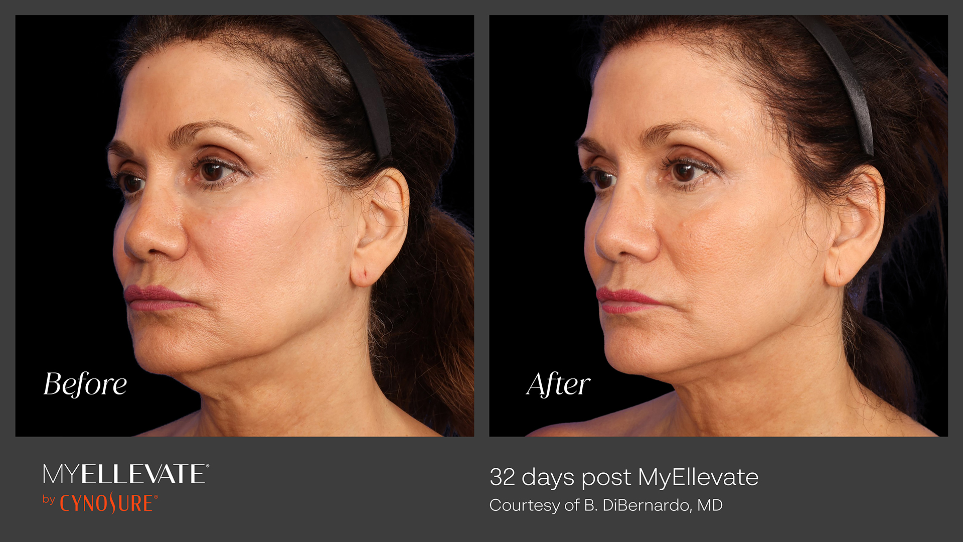 MyEllevate Before & After Gallery - Patient 218657 - Image 1