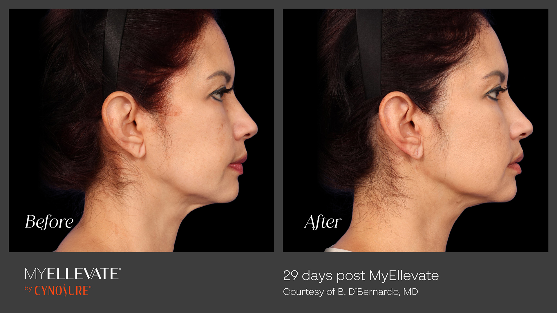 MyEllevate Before & After Gallery - Patient 371455 - Image 1