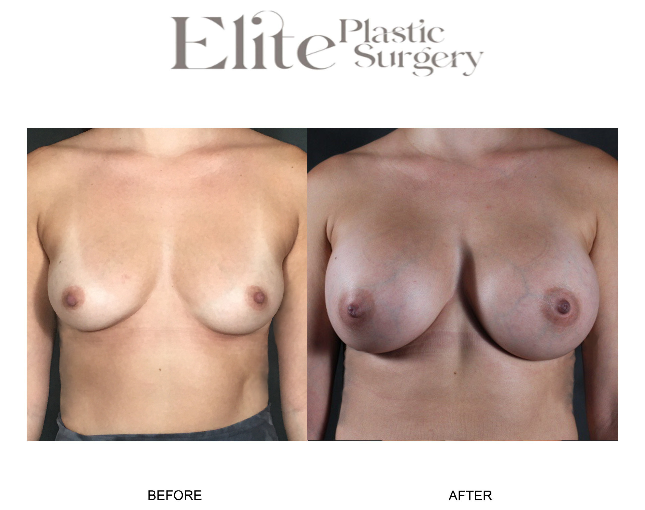 Breast Augmentation Before & After Gallery - Patient 335938 - Image 1
