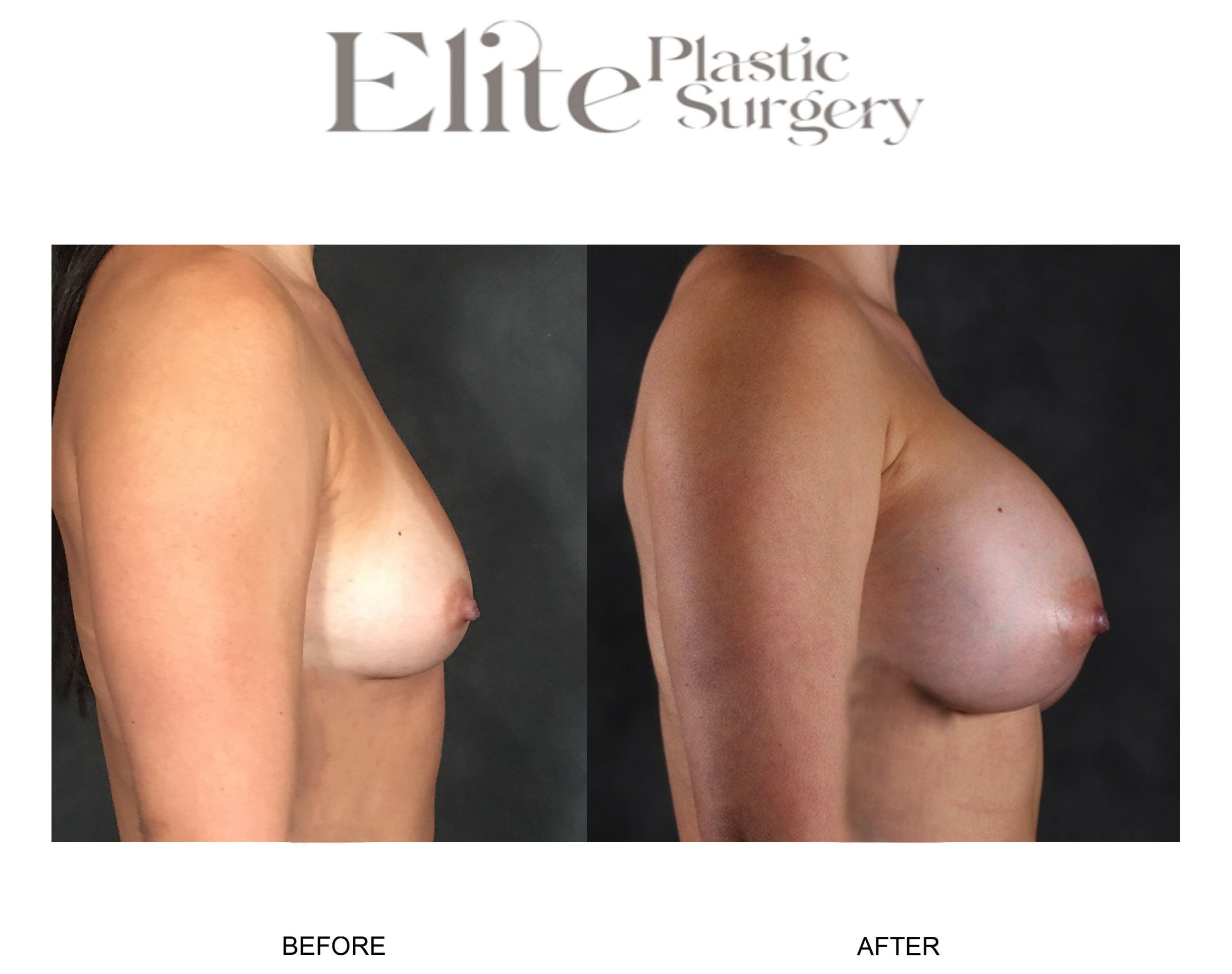Breast Augmentation Before & After Gallery - Patient 335938 - Image 2